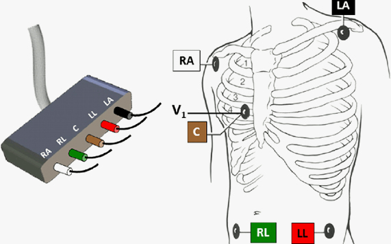 5-Electrode Technology